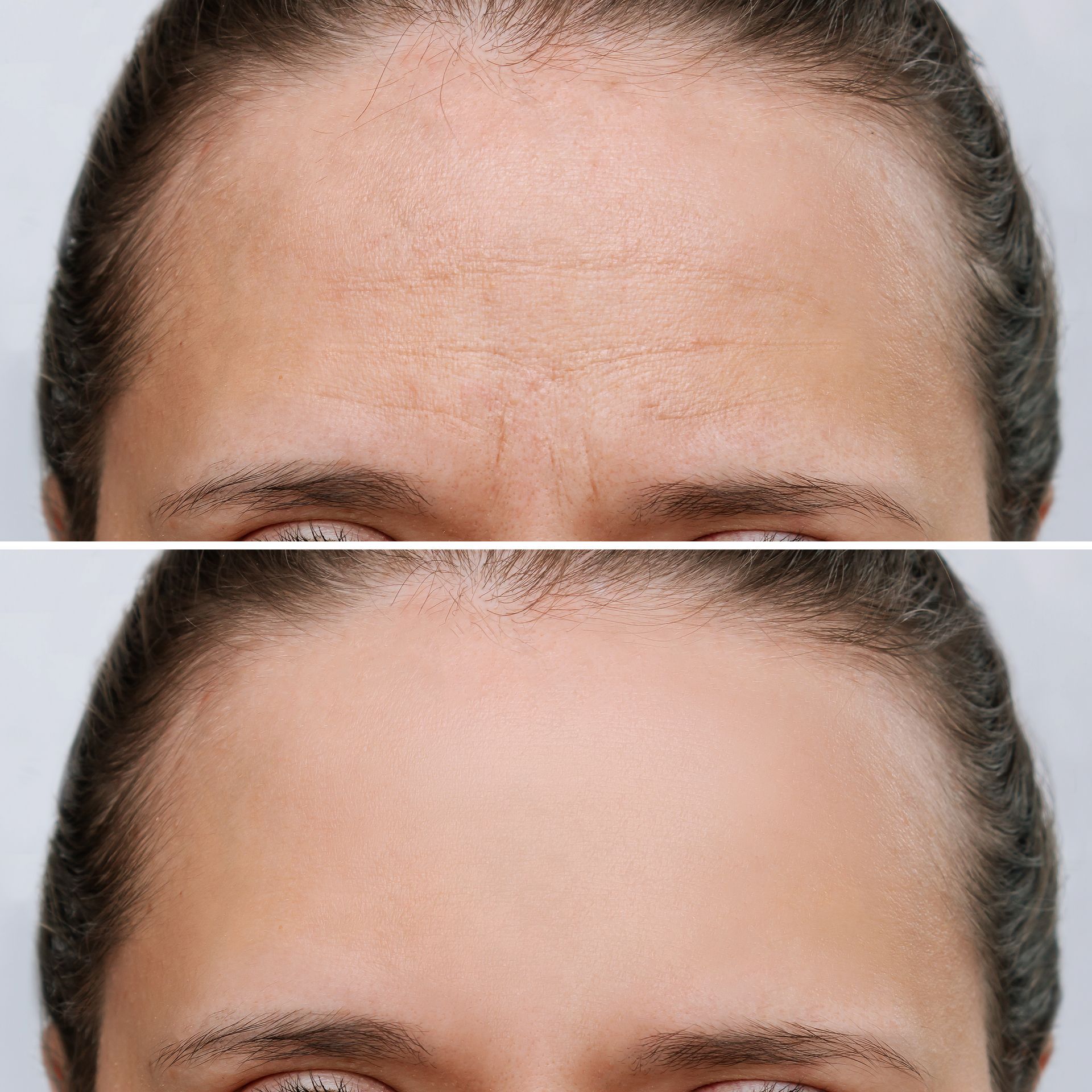 Forehead with wrinkles before and after treatment, showing smoothing effect.