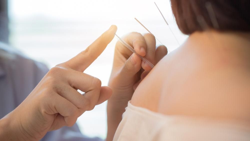 A Woman Is Getting Acupuncture On Her Back By A Doctor — Port Macquarie Physio & Pilates In Port Macquarie, NSW