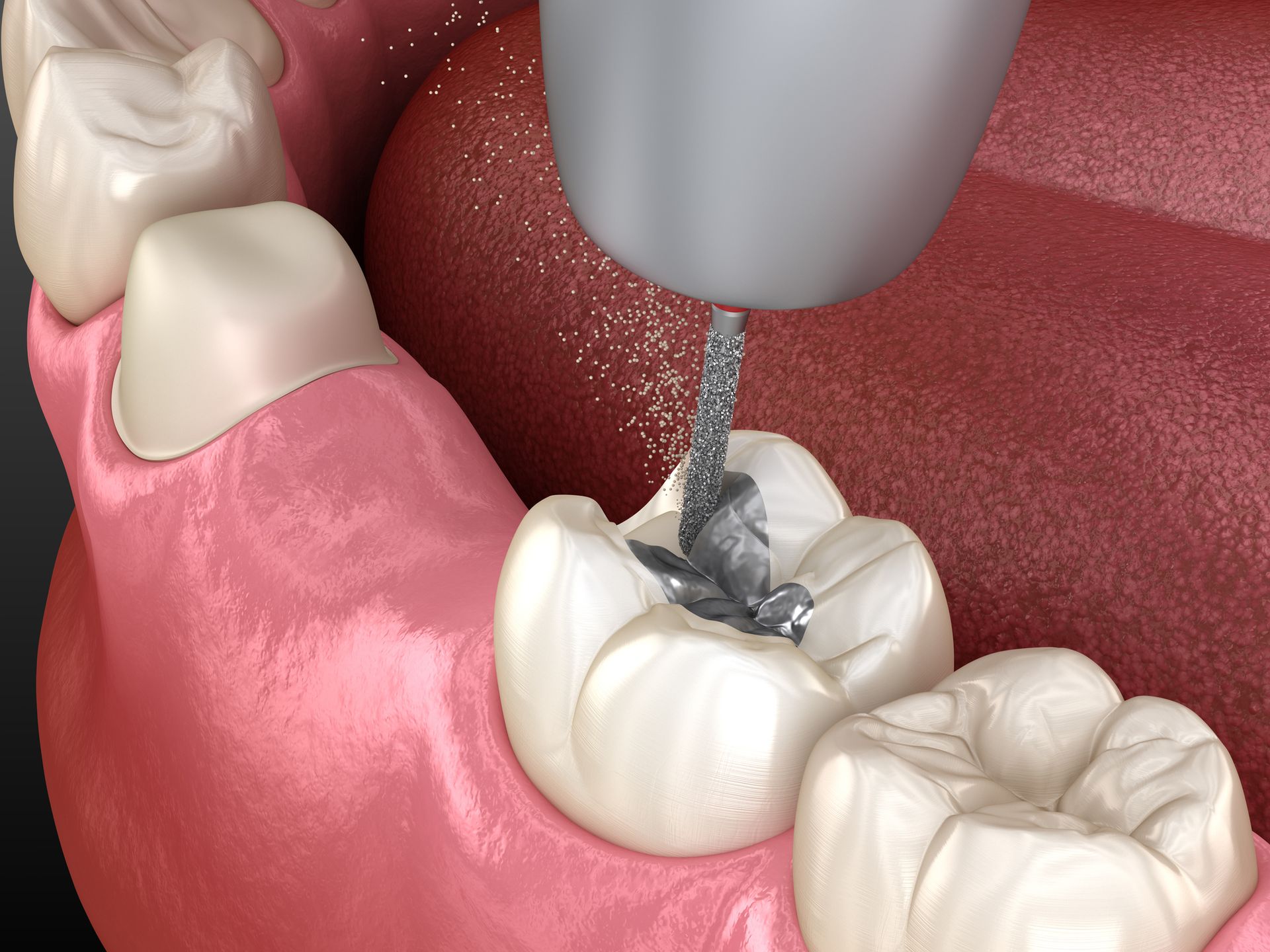 A computer generated image of a tooth being drilled with a drill.
