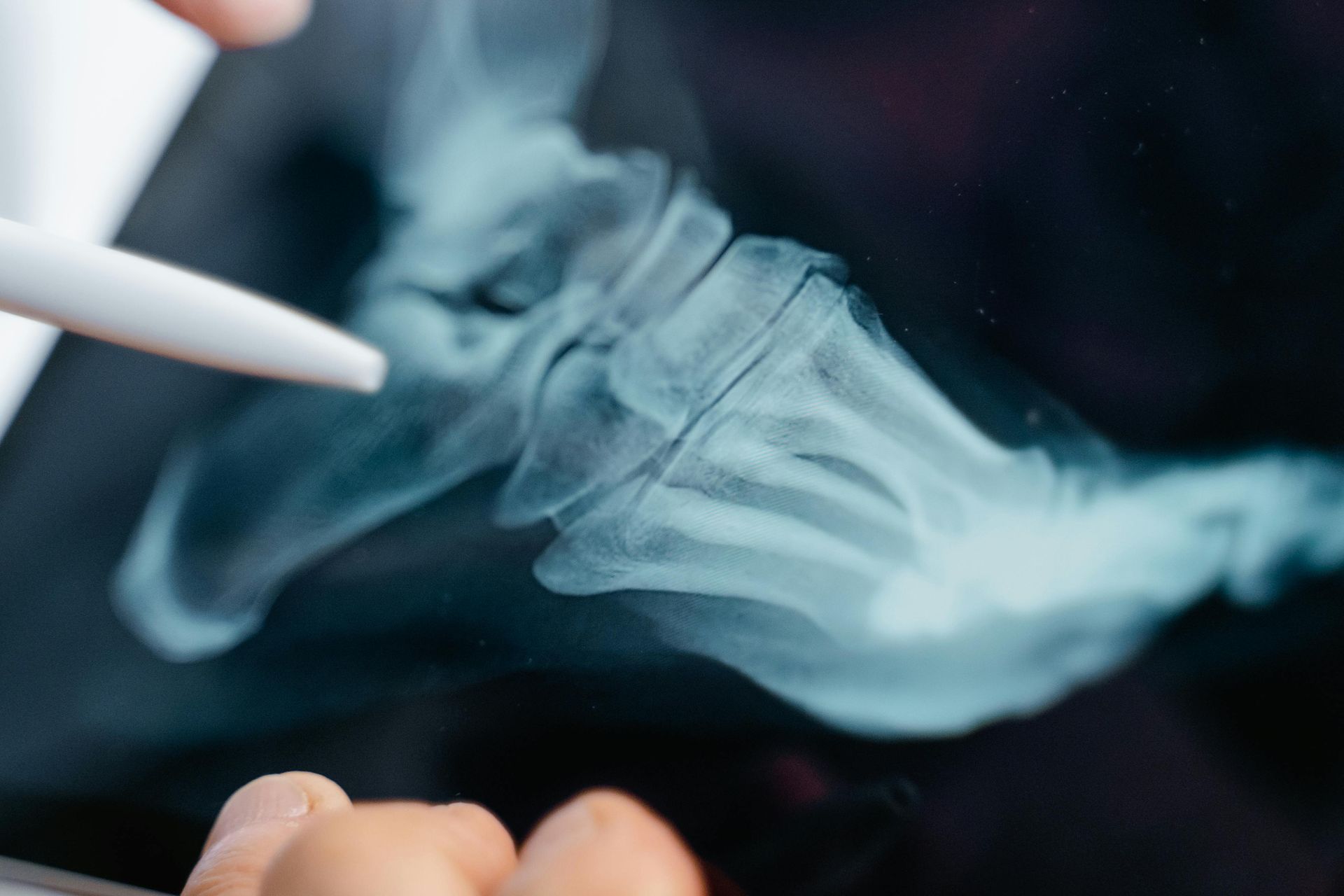 A person points with a stylus at a digital X-ray image of a human foot, highlighting the bones of the midfoot.
