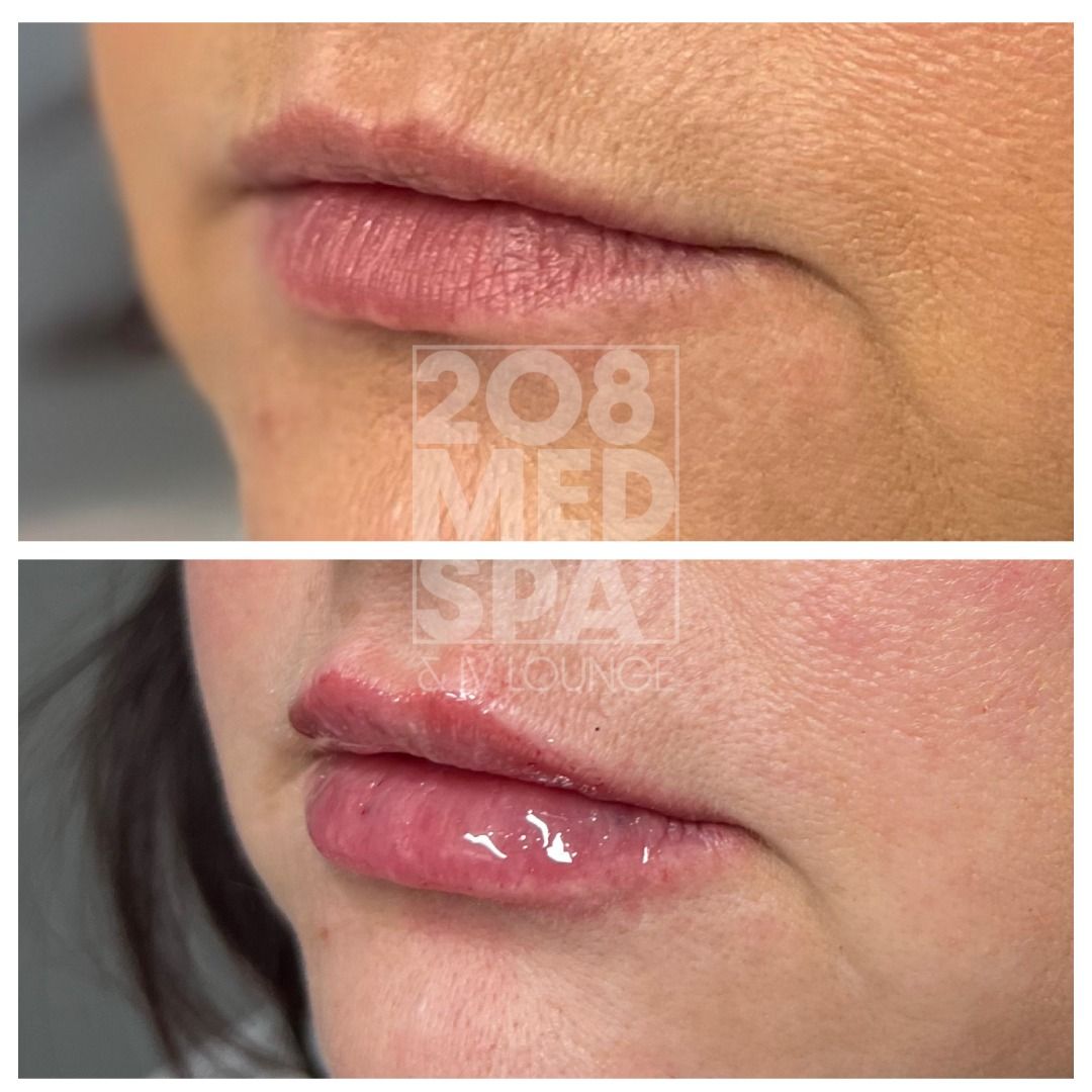 A before and after photo of a woman 's lips.