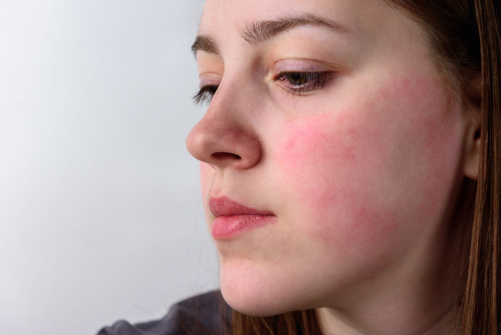 Woman with flushed cheeks, likely from a skin condition, looking down. Close-up profile.