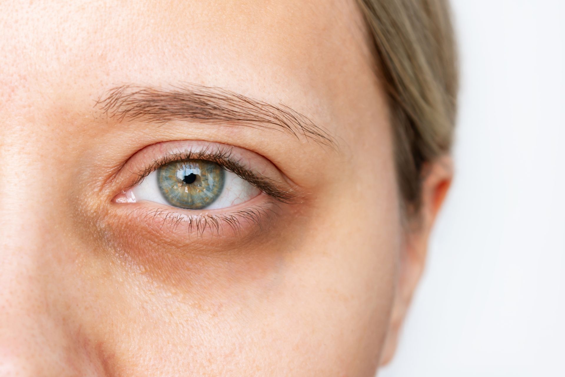 Close-up of a person's eye with dark circles under the eye. Pale skin, light-colored eye, neutral expression.