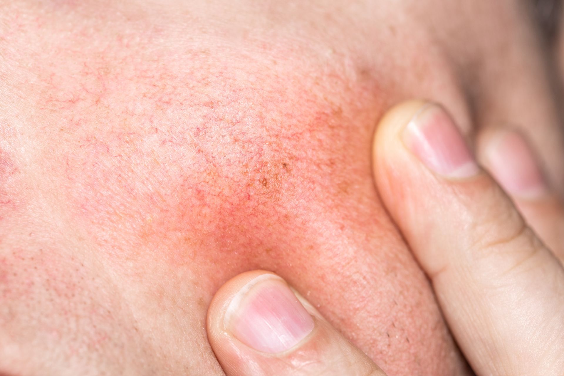 Close-up of a person's face showing red, irritated skin. A finger touches the affected area.
