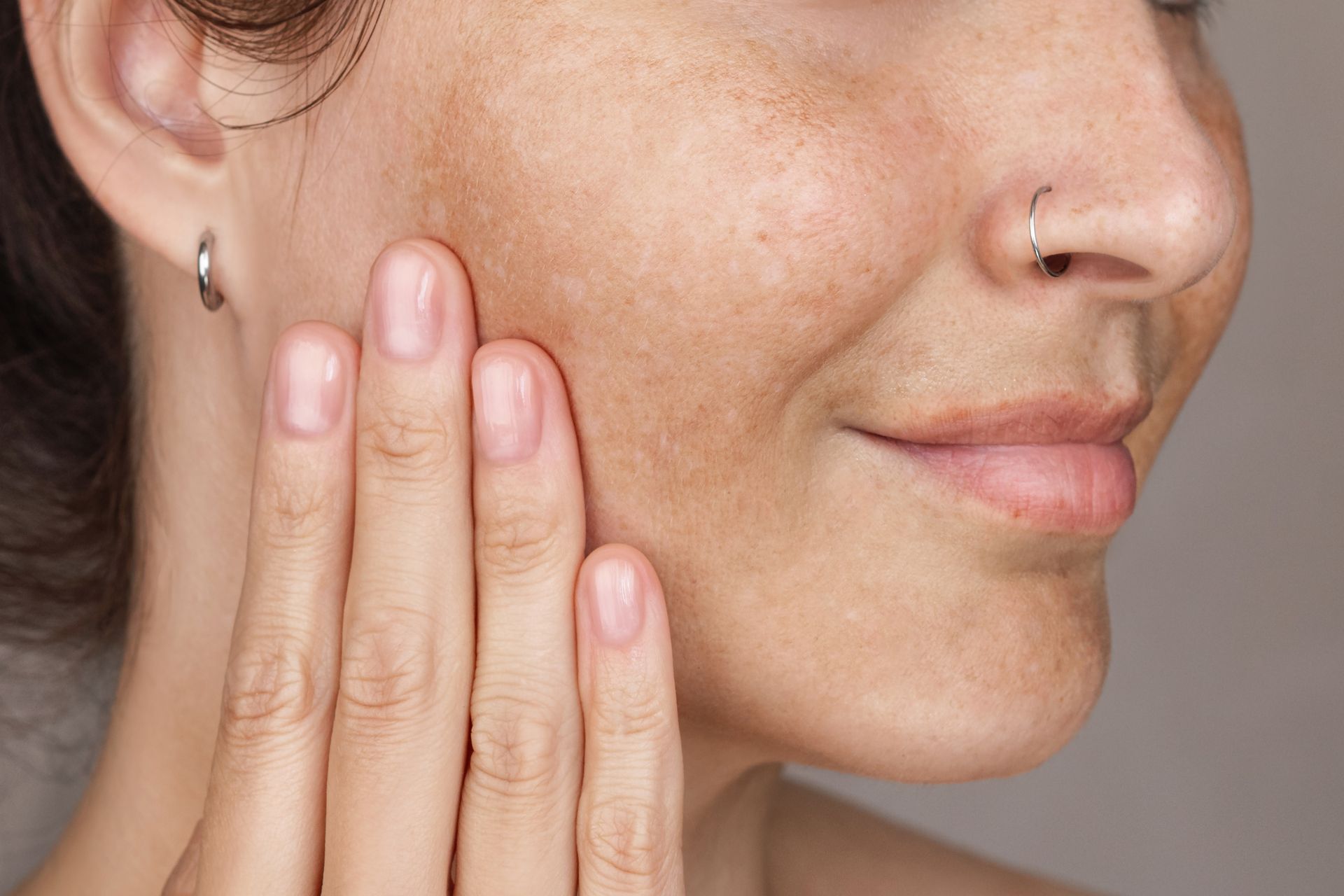 Woman with facial skin discoloration, touching her cheek.