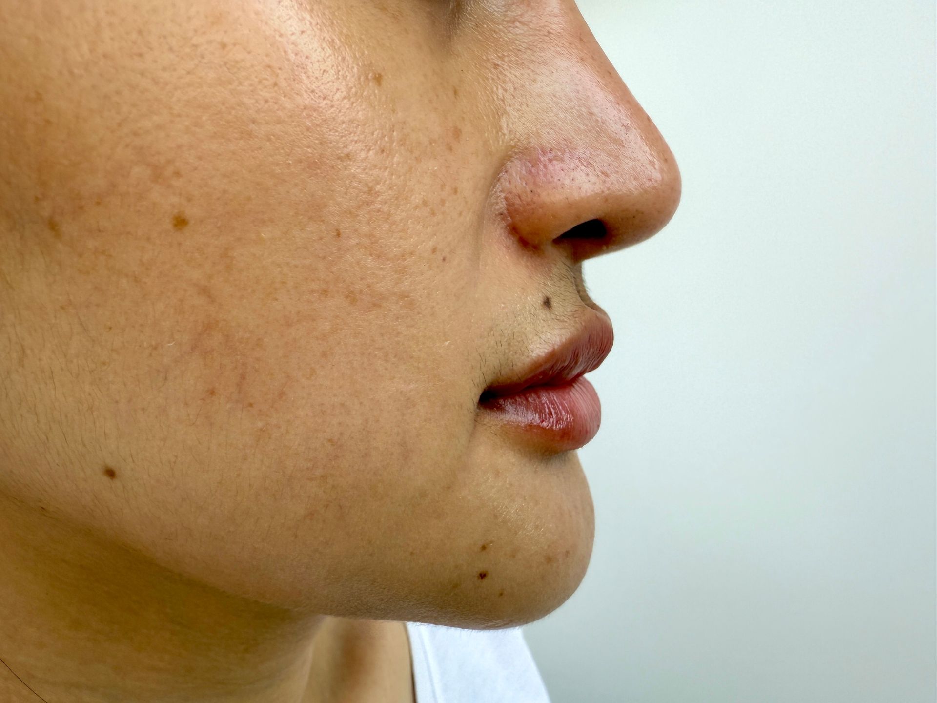 Profile view of a person's face; visible skin texture, freckles, and moles; nose, lips, and chin prominent against a white background.