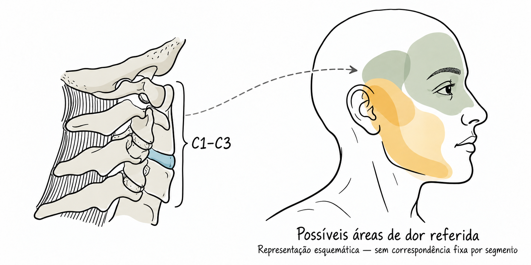 Território de dor referida para dor cervical alta ( C1 a C3) 