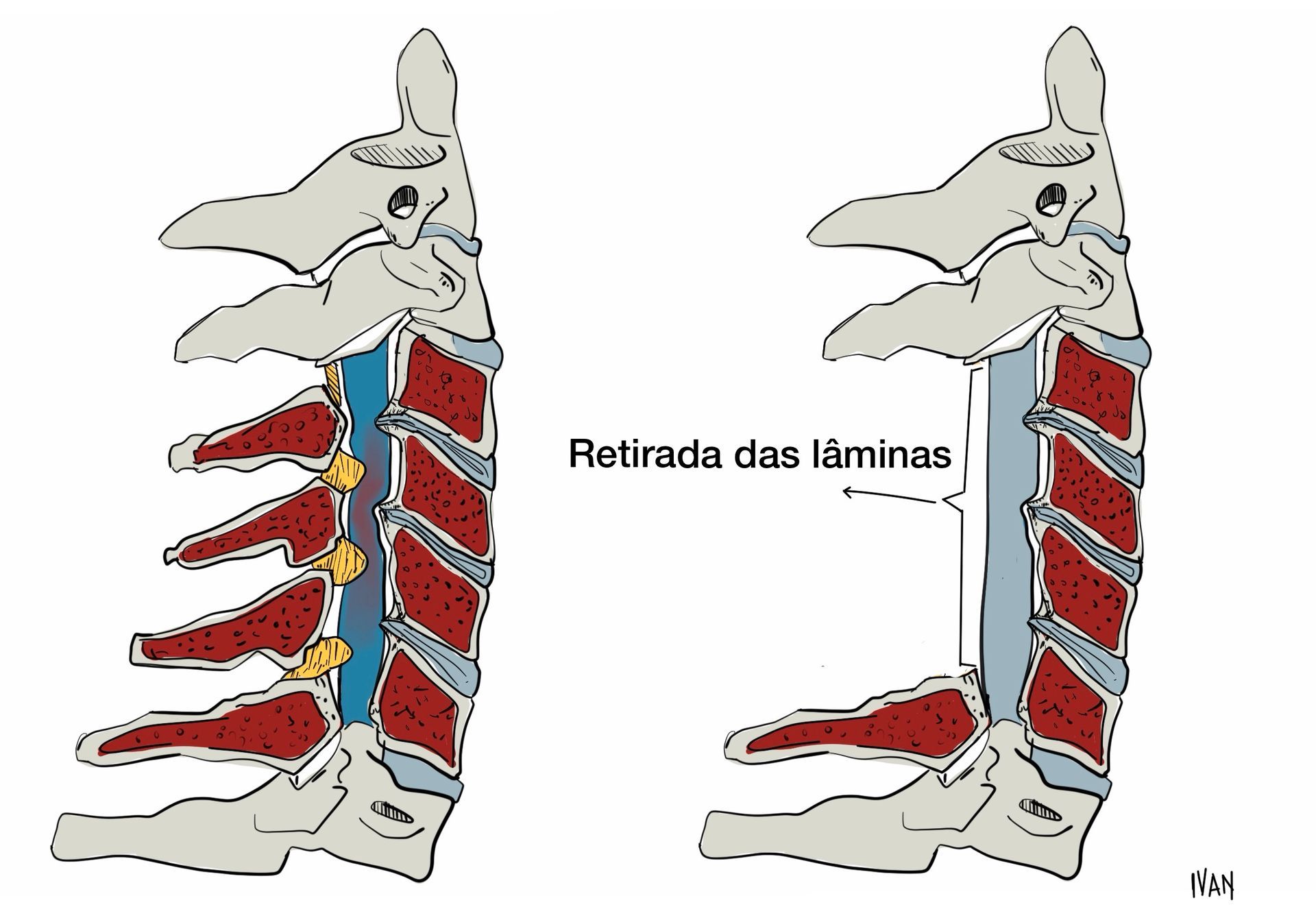 Laminectomia Posterior Cervical