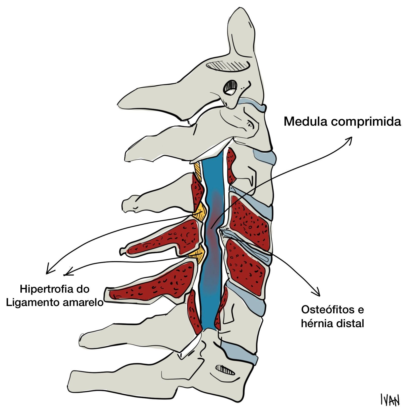 Ilustração da estenose cervical: estreitamento do canal vertebral comprimindo a medula