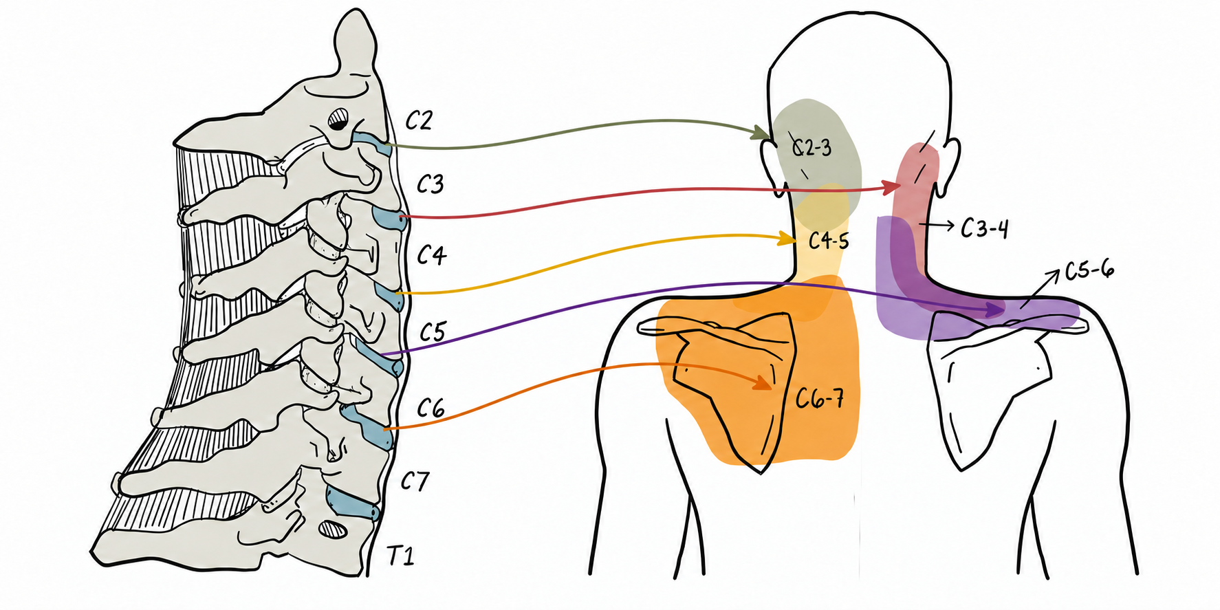 Região de dores referidas das inflamações cervicais