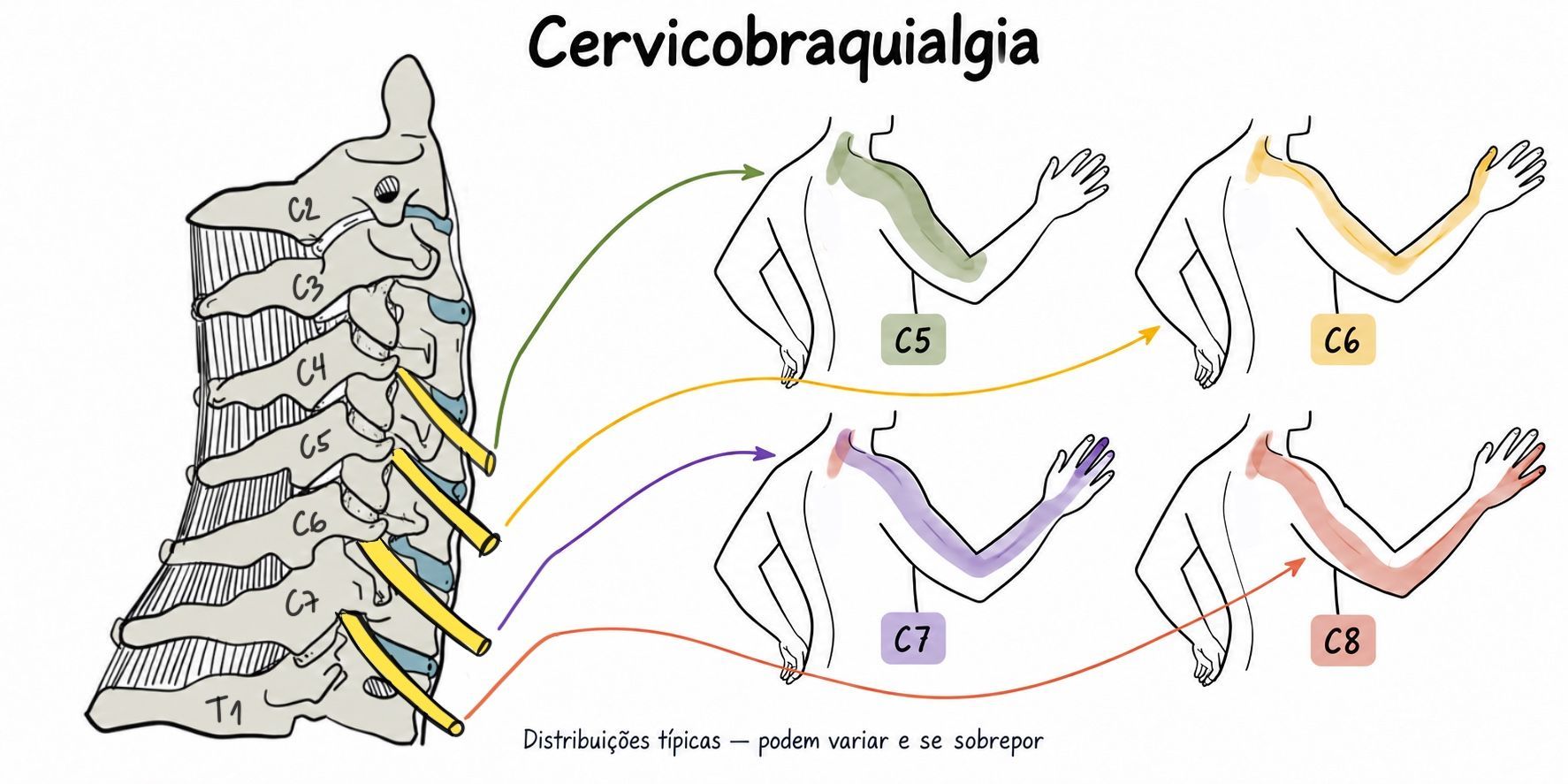 Território de dor irradiada de raizes cervicais