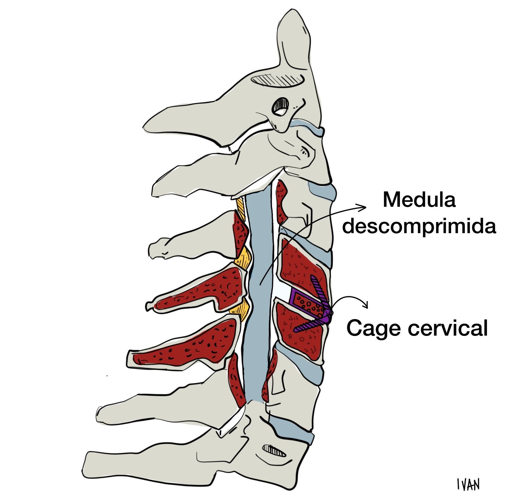 descompressao cervical anterior com cage 