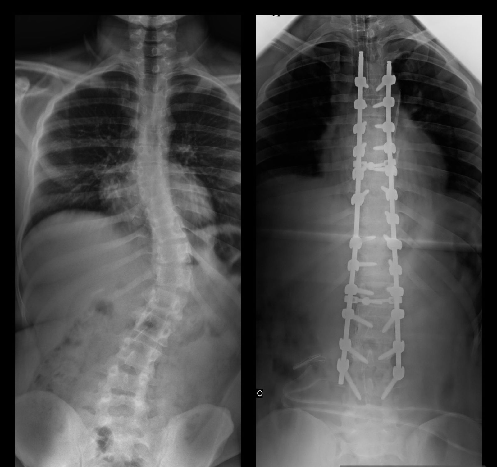 exemplo de escoliose operada dr ivan 1