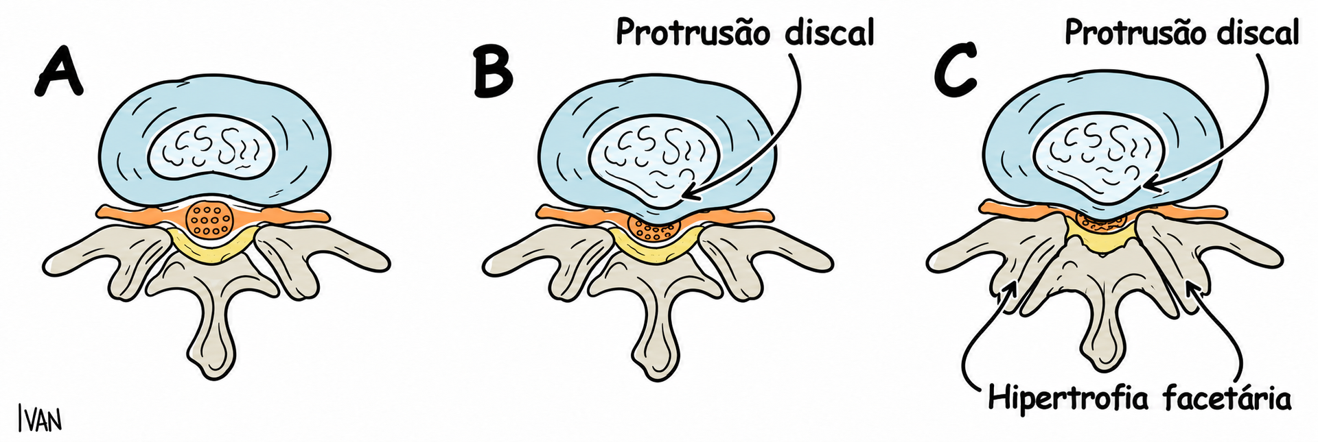 evolução da estenose de canal