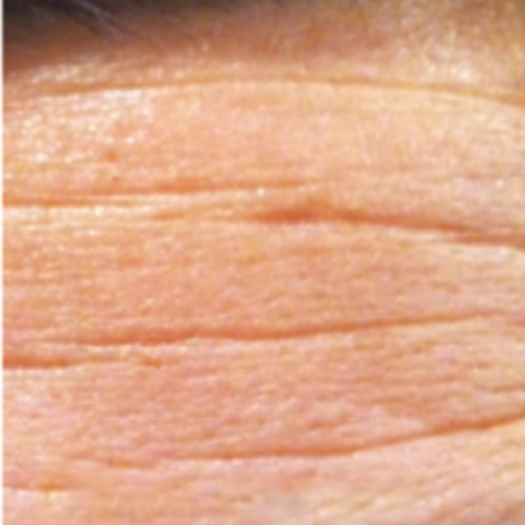 A close-up view of textured, fair skin showing fine lines and wrinkles.