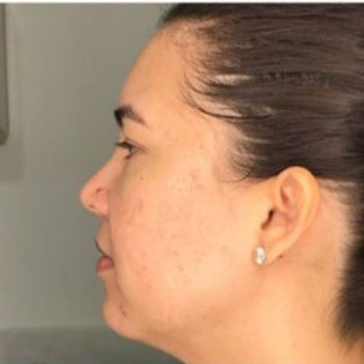 A close-up profile view of a person's face showing skin texture and features, viewed from the side against a neutral wall.