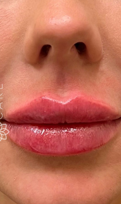 A close-up view of a person's mouth with visibly plumped, glossy pink lips.
