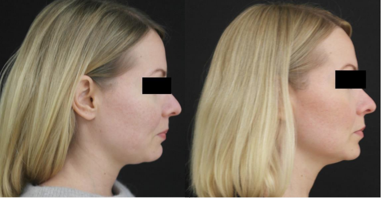 A before and after photo of a woman 's face