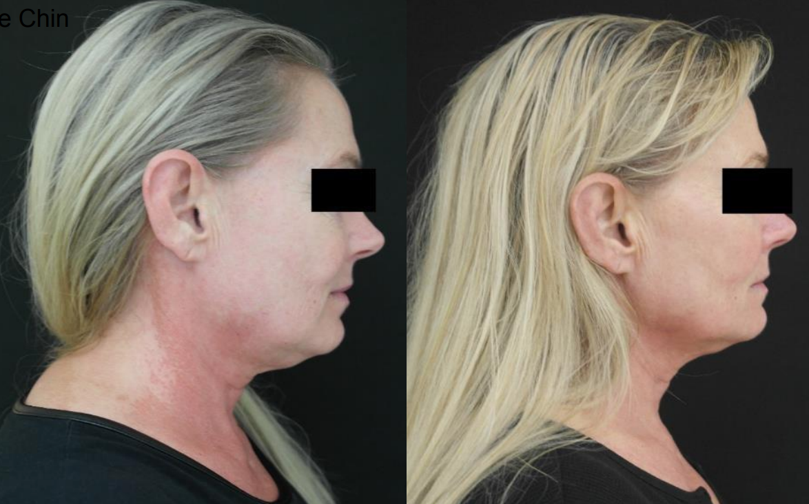 A before and after photo of a woman 's neck and face