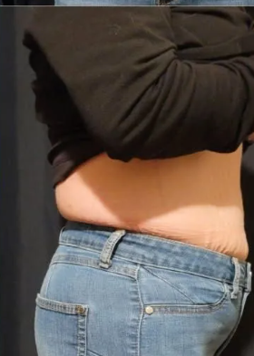 Recent Abdominal fat reduction from non-surgical body contouring