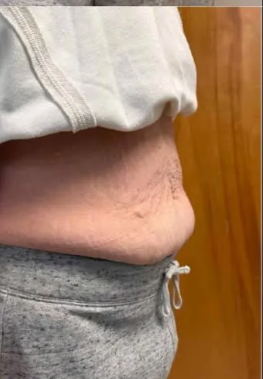Recent Abdominal fat reduction from non-surgical body contouring