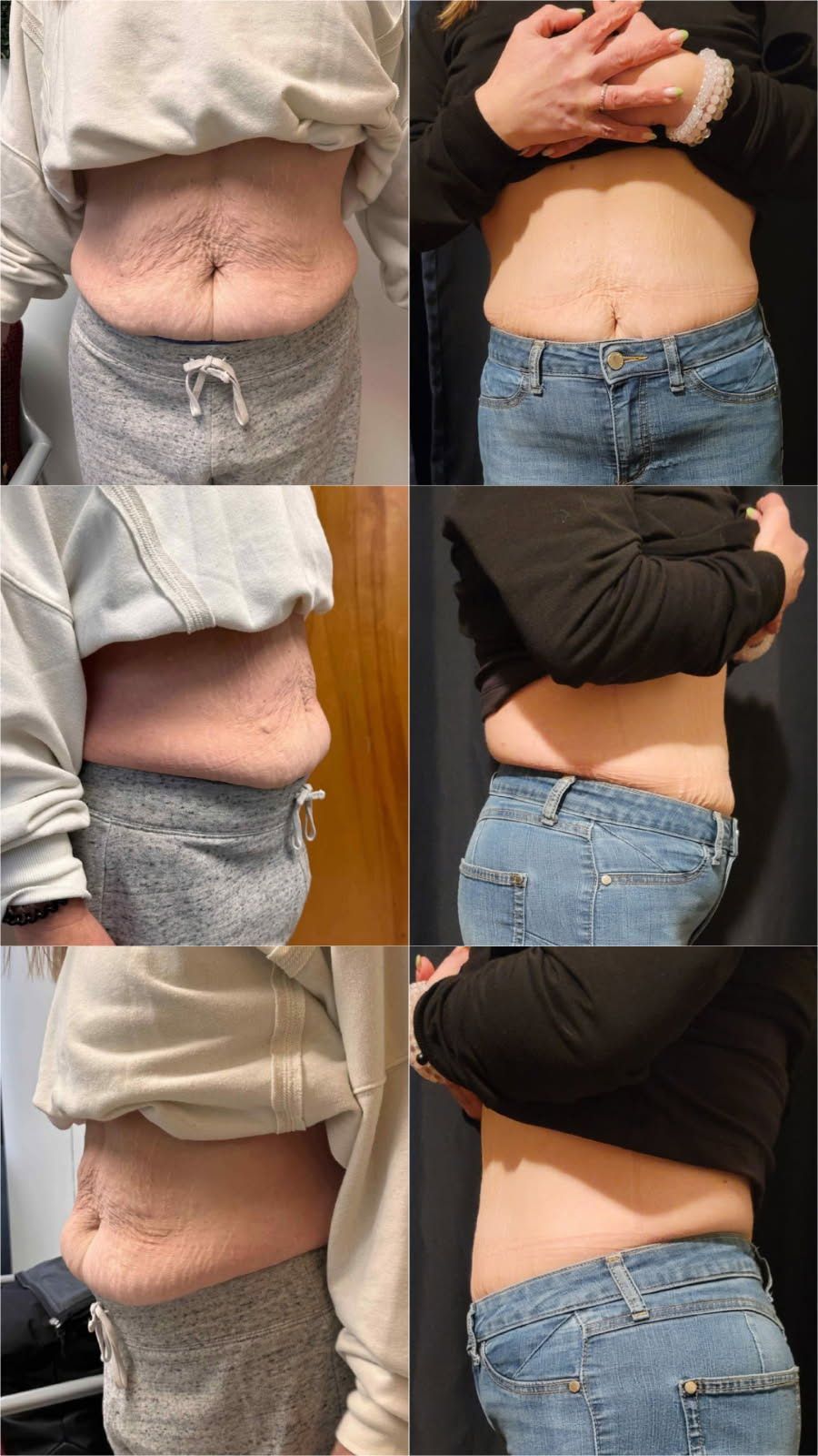 Ultra Cavitation treatment results