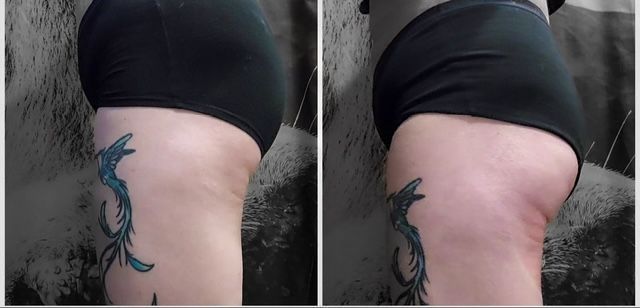 Butt Lift body Contouring in Springfield, MA