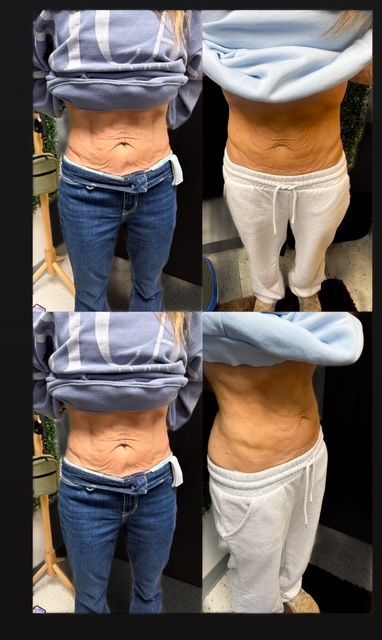 Recent Skin Tightening Results from Body Sculpting