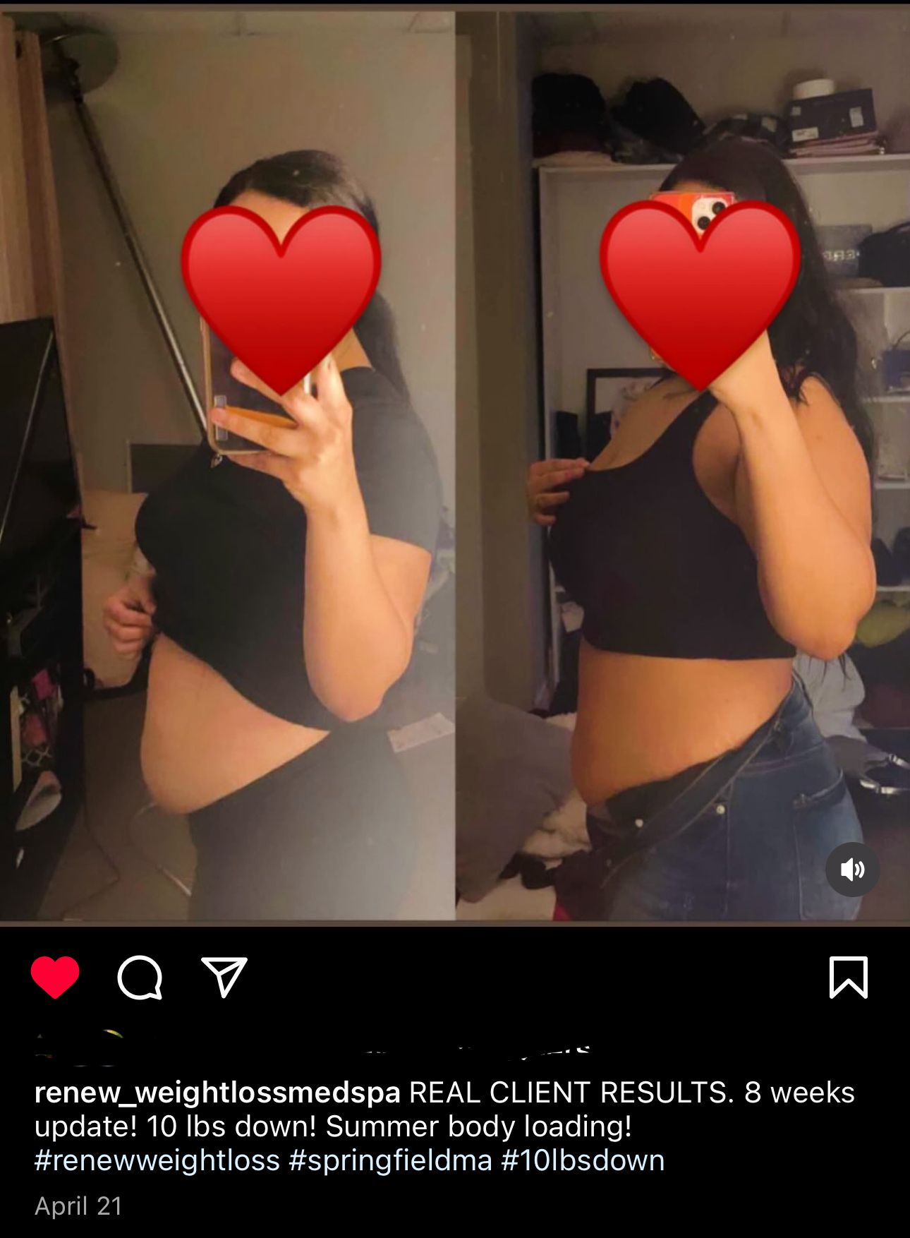 Flat Tummy body contouring in Springfield