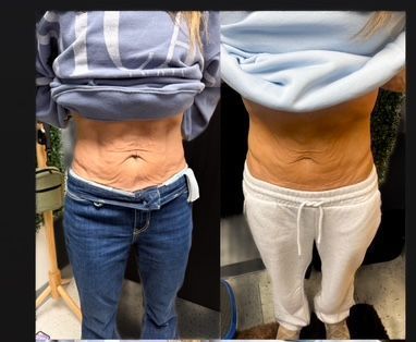 Recent Skin Tightening Results from Body Sculpting