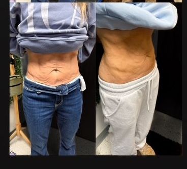 Recent Skin Tightening Results from Body Sculpting