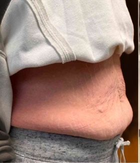Recent Abdominal fat reduction from non-surgical body contouring
