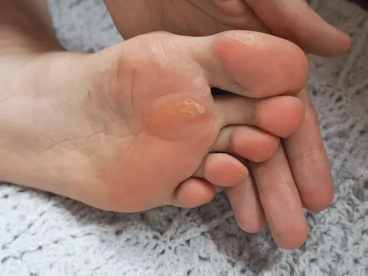 Calluses on the ball of the foot caused by pressure from enclosed footwear during winter.