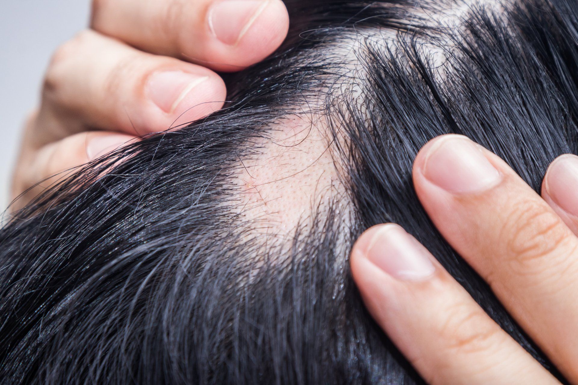 alopecia patient showing bald spots on scalp