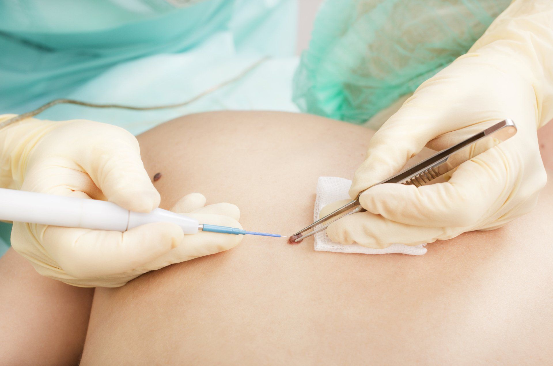 dermatologist performing electrodessication and curettage procedure