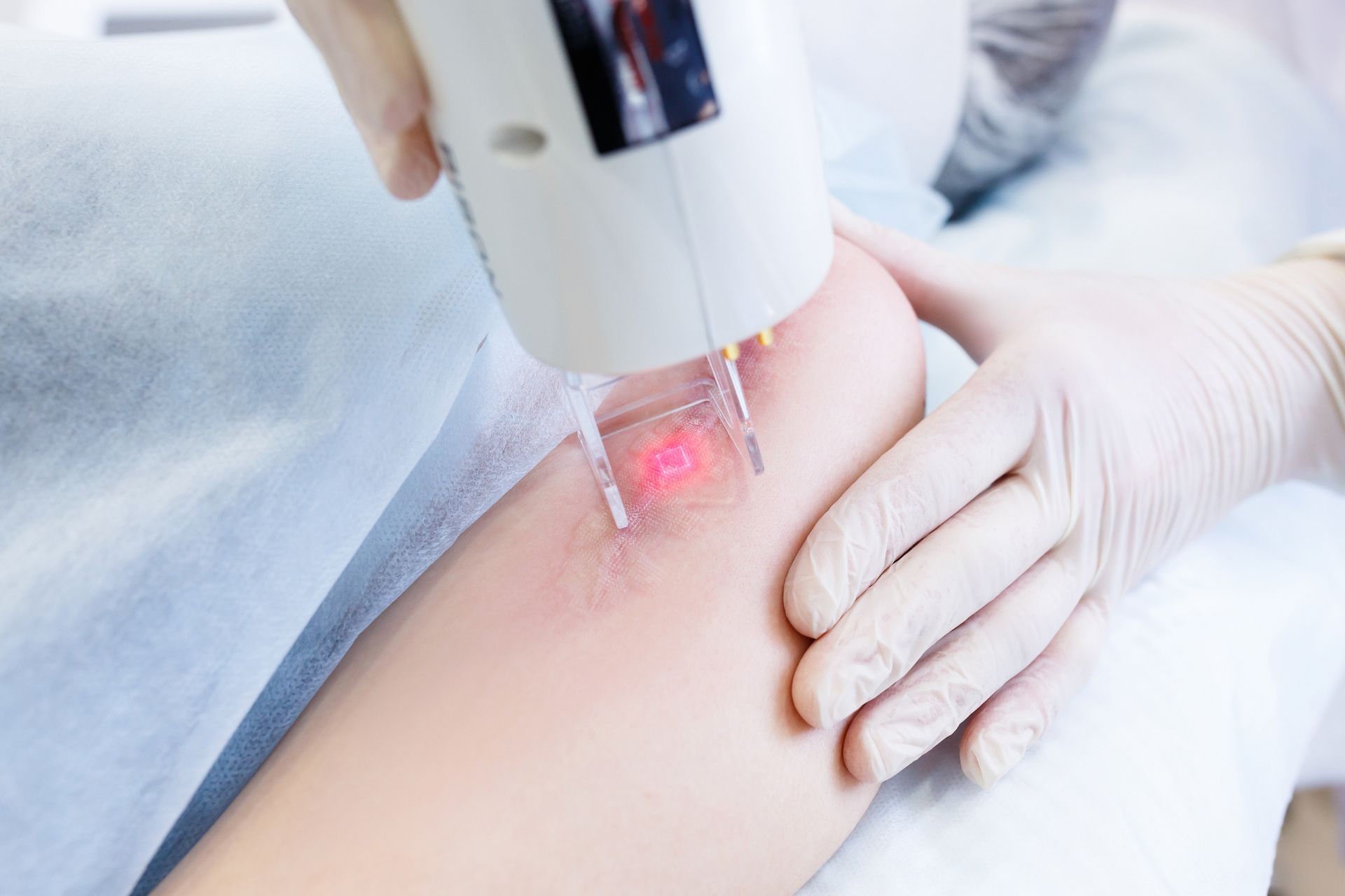 closeup of dermatologist using laser device on scar