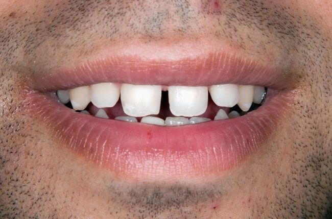 Invisalign before