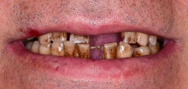 smile reconstruction before