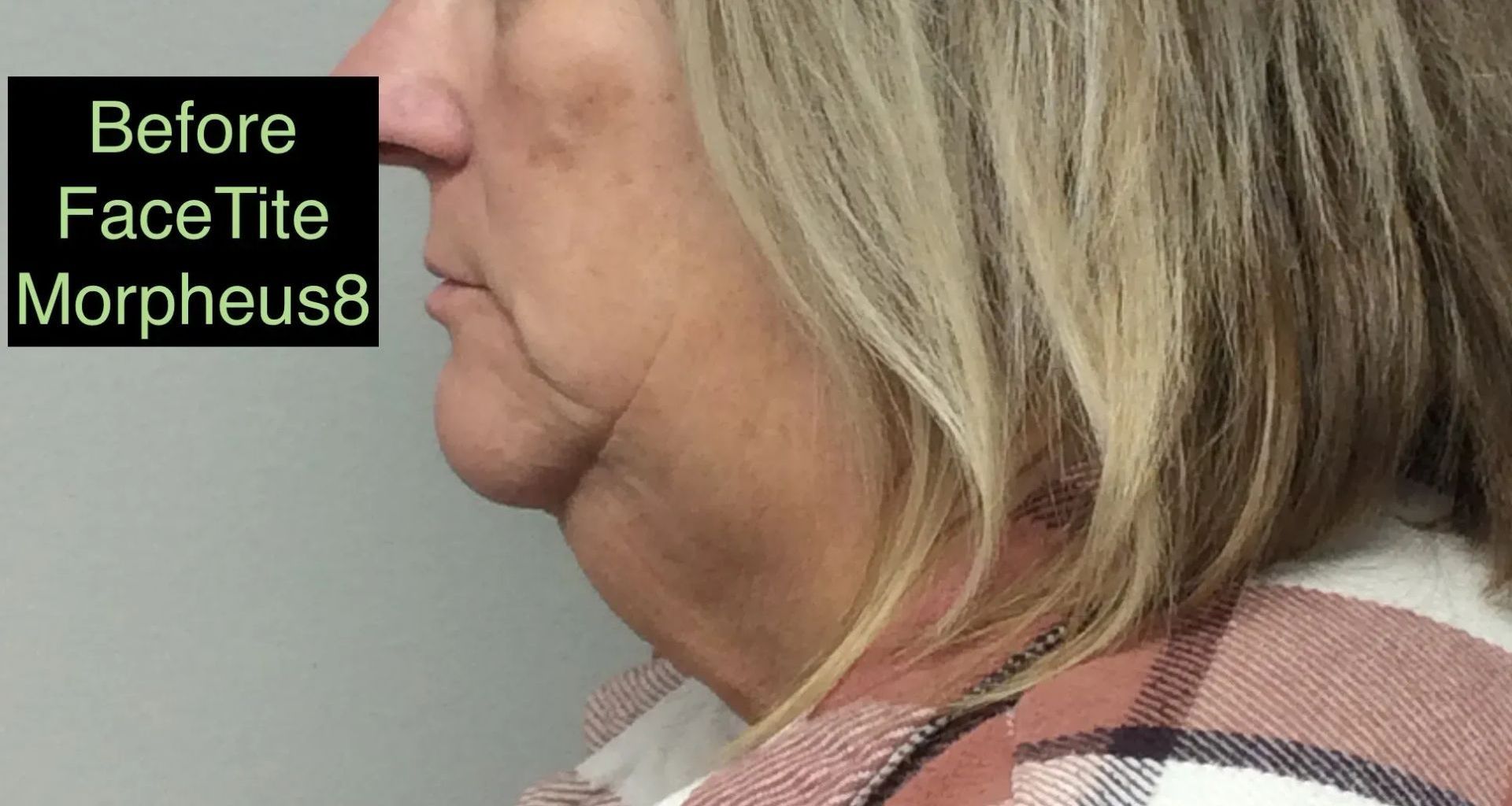 a woman 's face is shown before facetite morpheus8