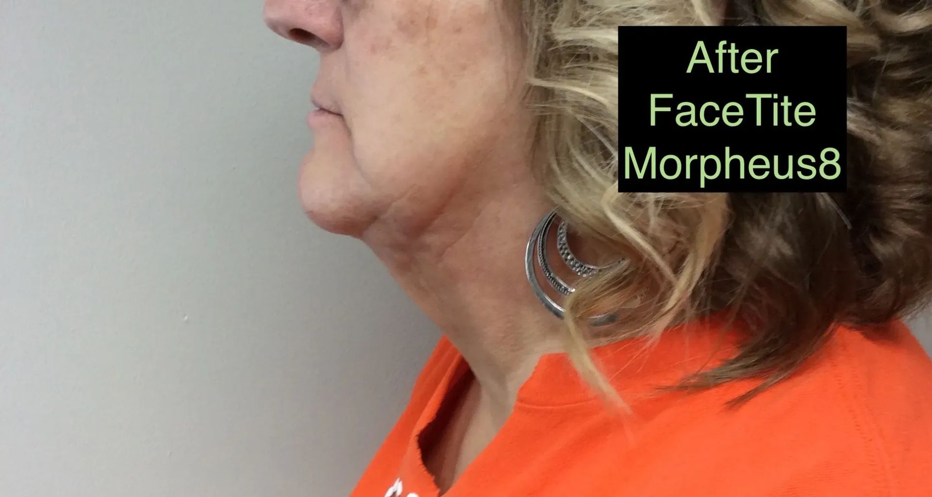 a picture of a woman's face with the caption after face tite morpheus8