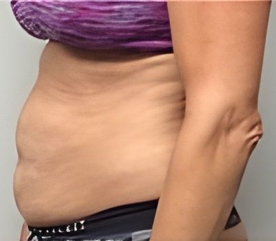 a woman in a purple top and black underwear before lipo, bodytite and Morpheus8 has a very large belly .