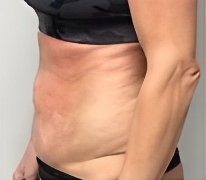 the woman is wearing a black bra and black underwear 1 day after lipo treatment.