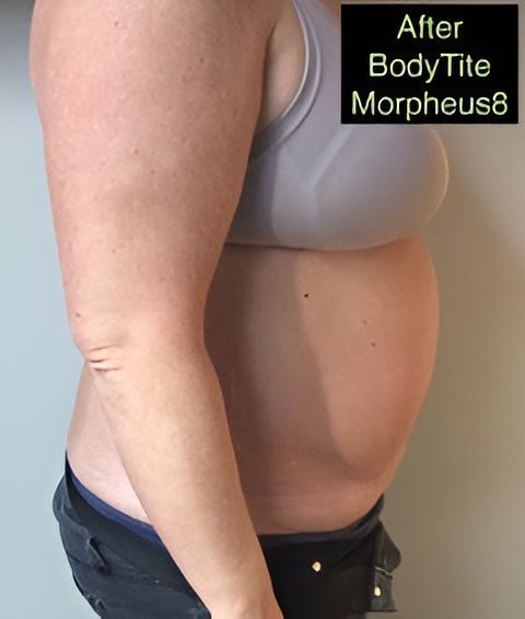 a woman 's torso is shown with the words after bodytite morpheus