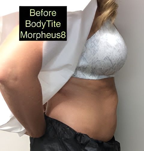 a picture of a woman 's stomach before bodytite morpheus8