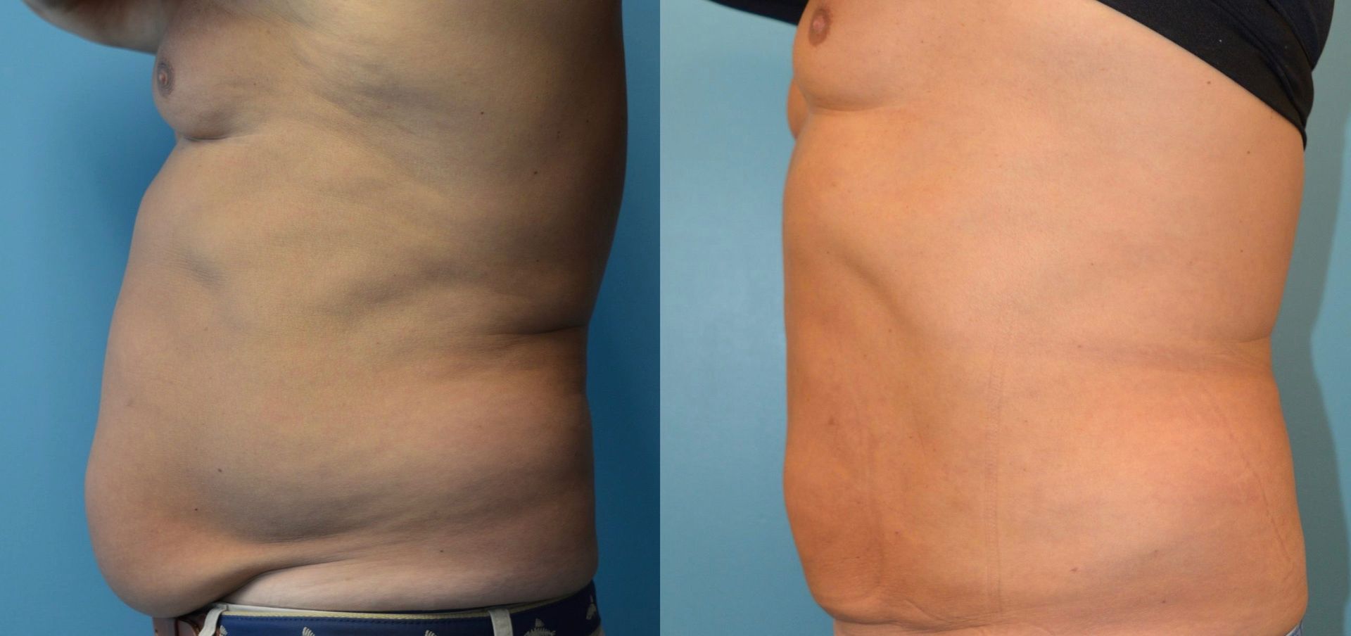 A before and after picture of a man 's stomach.