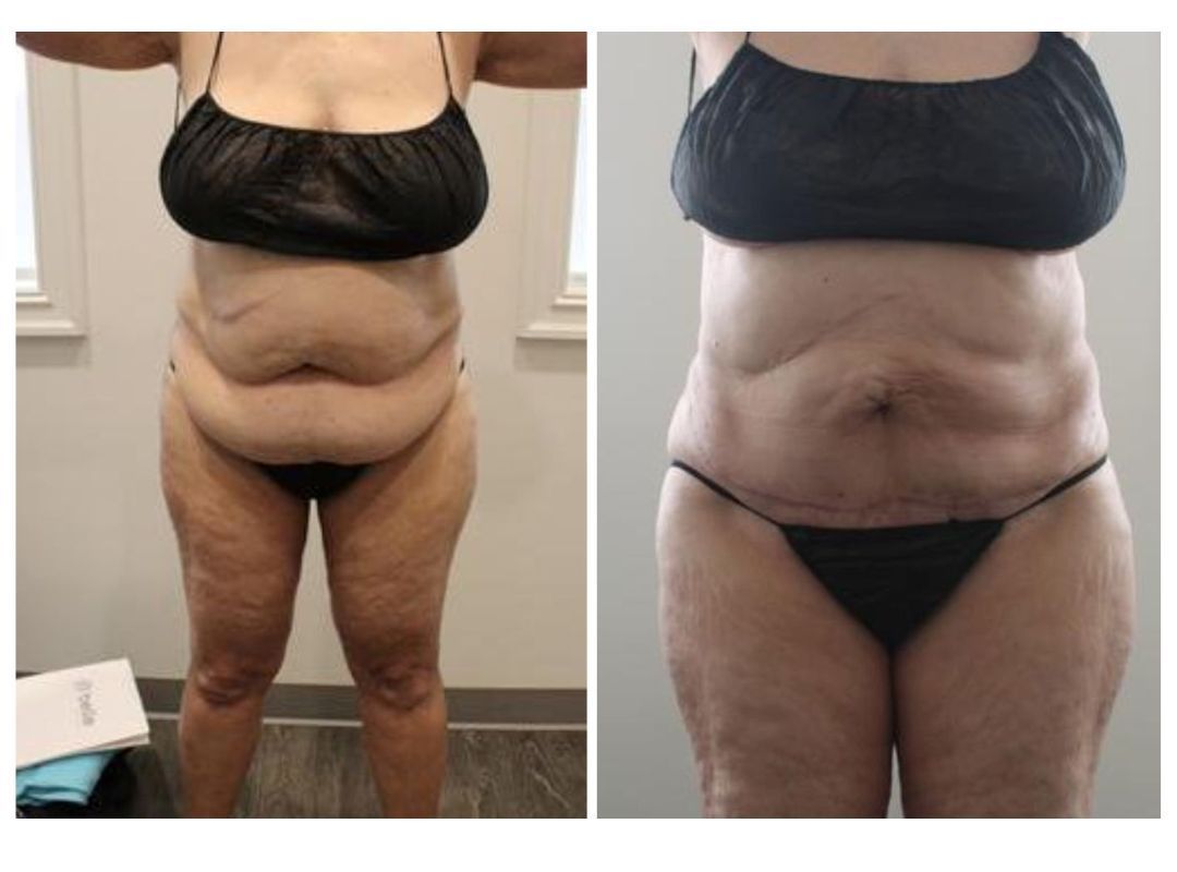 A before and after photo of a woman 's body