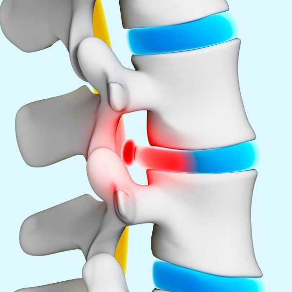 A model of a spine displaying a herniated disc