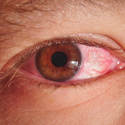 person with Pink Eye