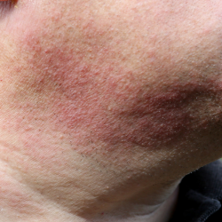 poison ivy rash
