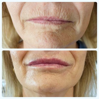 A before and after photo of a woman 's lips.